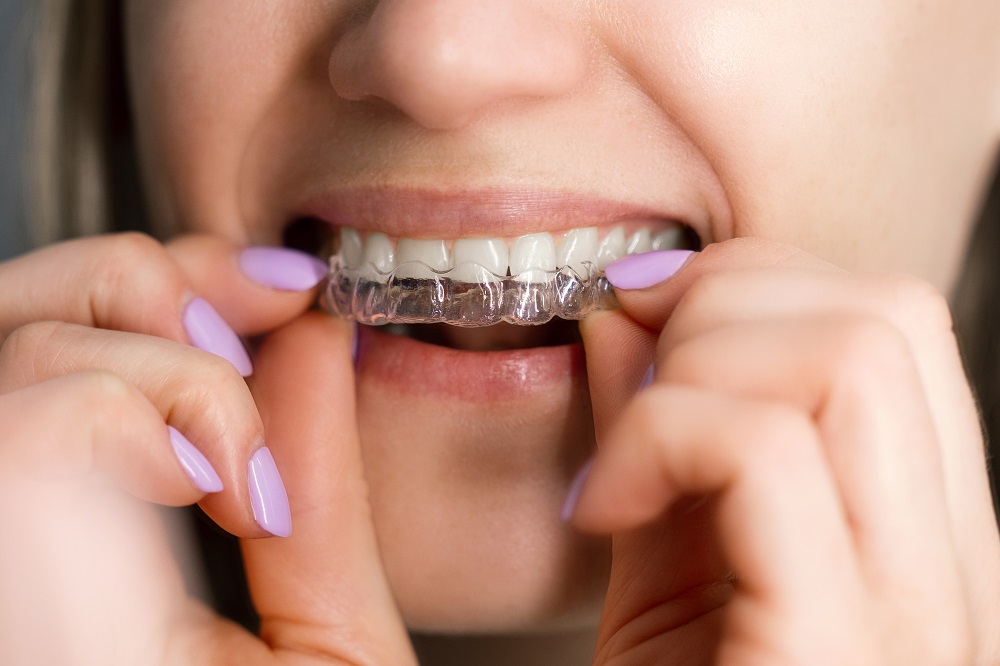clear dental aligners