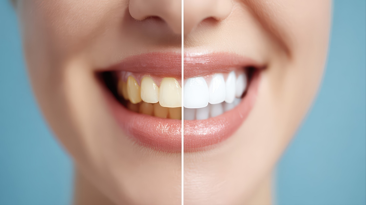 teeth whitening transformation before and after